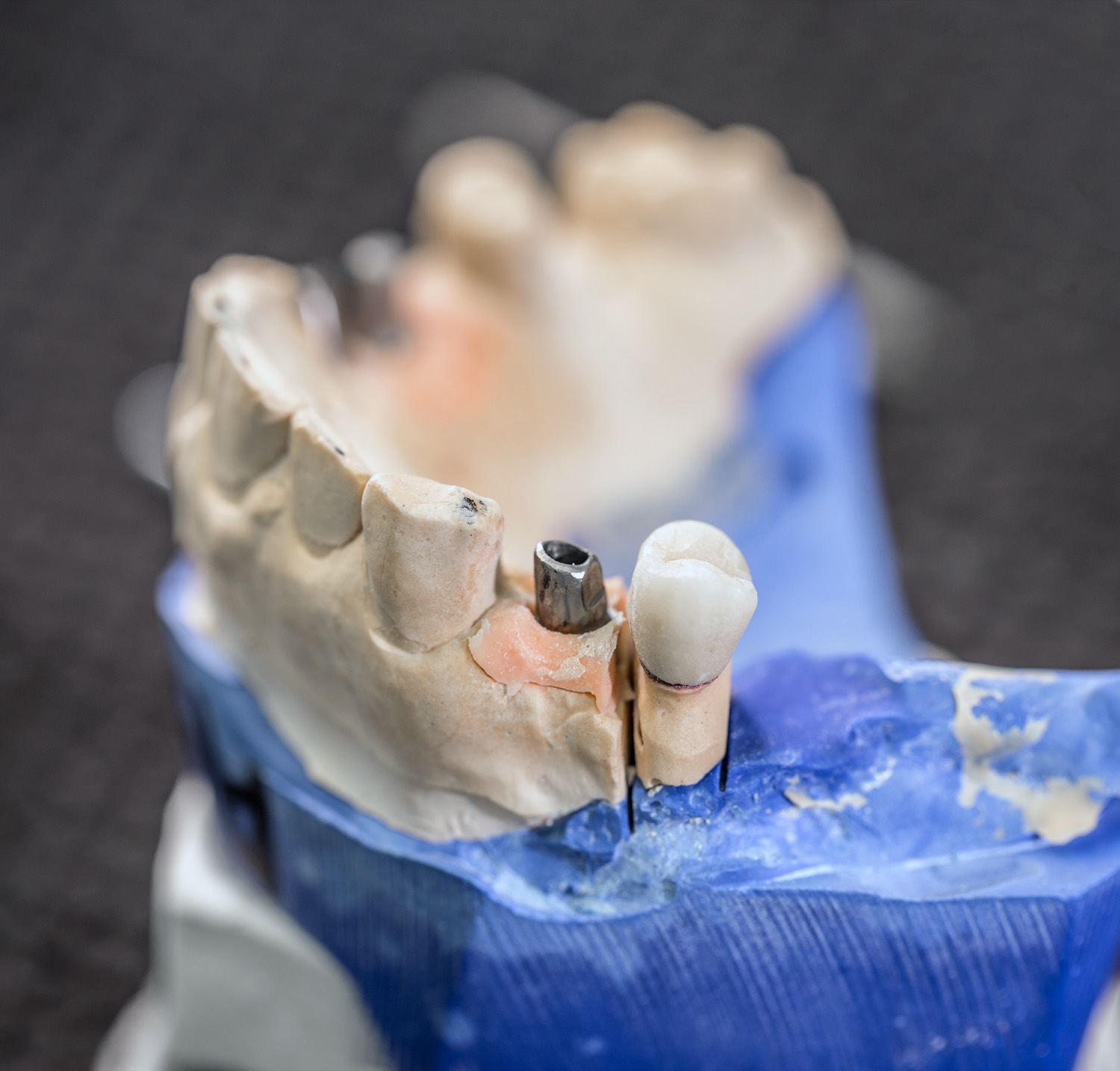 All-on-X Implants at Smile Boutique Thousand Oaks — 3