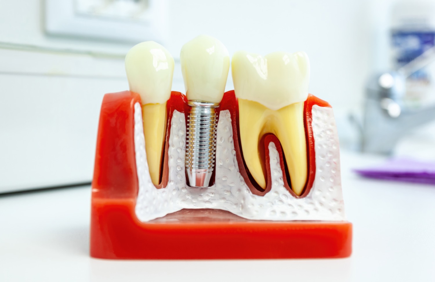 All-on-X full-arch dental implants in Thousand Oaks
