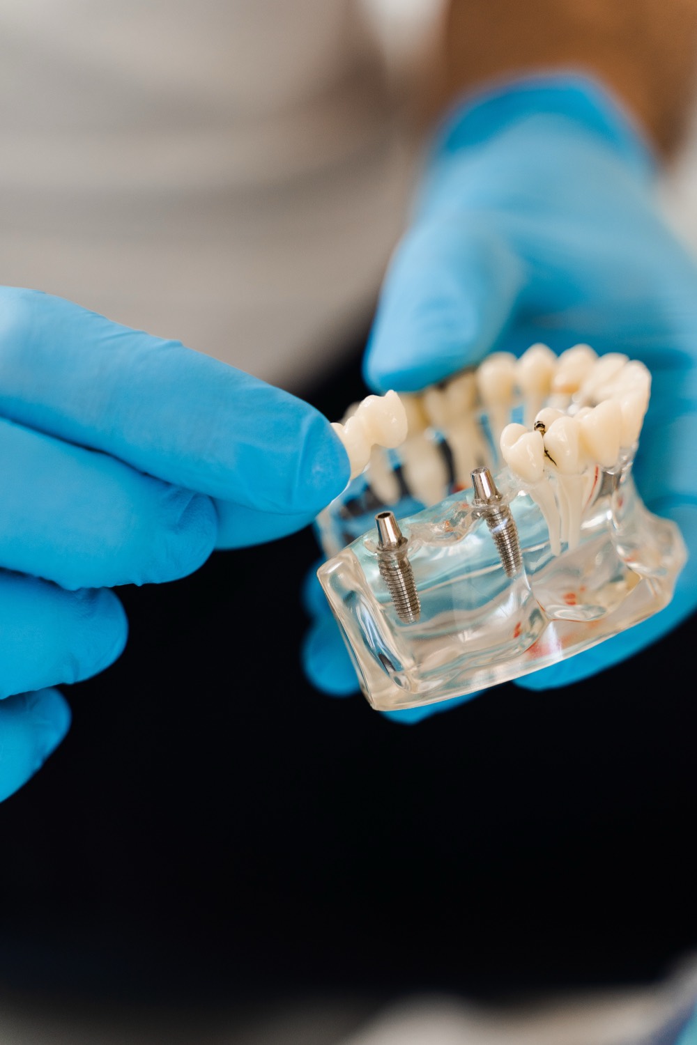 Dental implants in Thousand Oaks