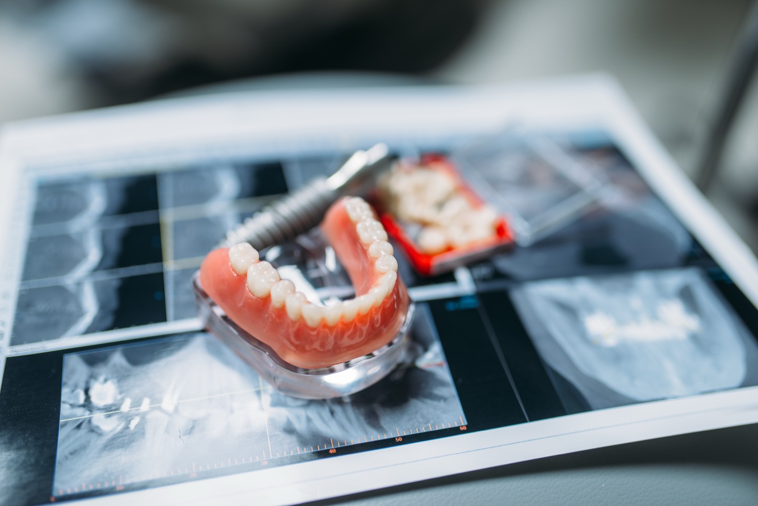 Implant-secured denture stabilization in Thousand Oaks
