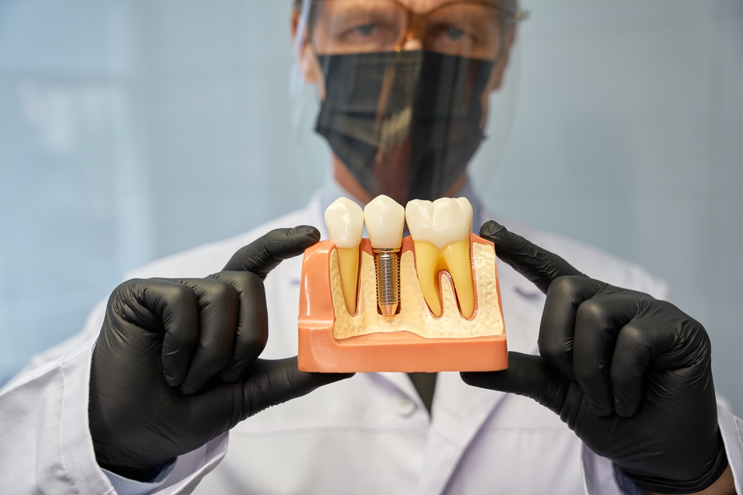 All-on-X Implants — Smile Boutique Thousand Oaks